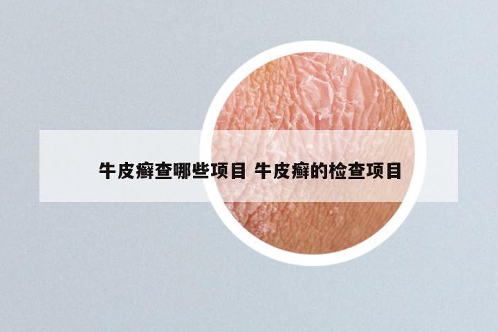 牛皮癣查哪些项目 牛皮癣的检查项目