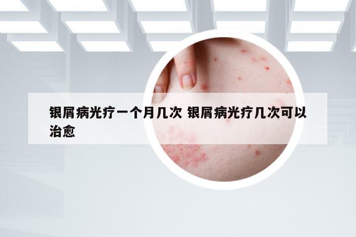银屑病光疗一个月几次 银屑病光疗几次可以治愈