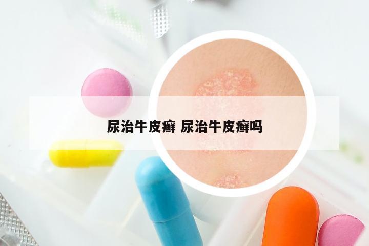 尿治牛皮癣 尿治牛皮癣吗