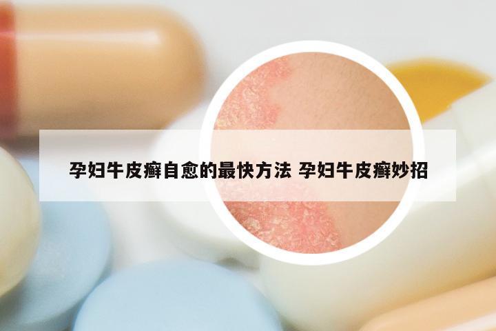 孕妇牛皮癣自愈的最快方法 孕妇牛皮癣妙招