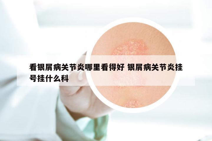 看银屑病关节炎哪里看得好 银屑病关节炎挂号挂什么科