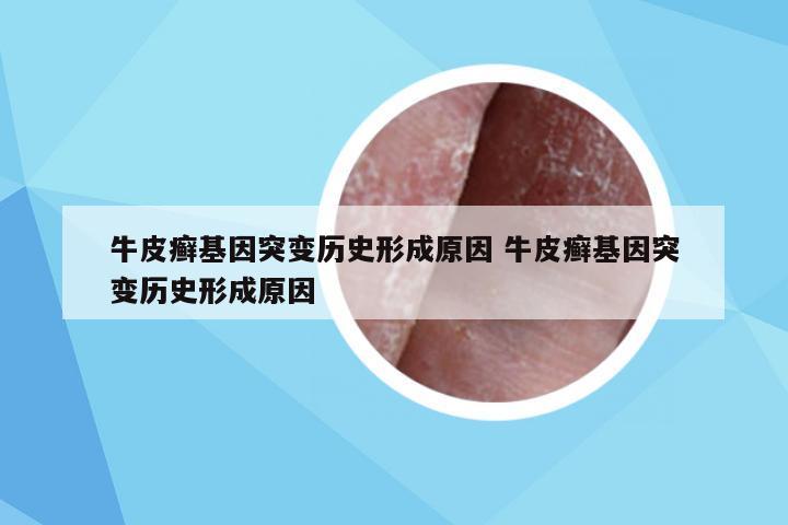 牛皮癣基因突变历史形成原因 牛皮癣基因突变历史形成原因