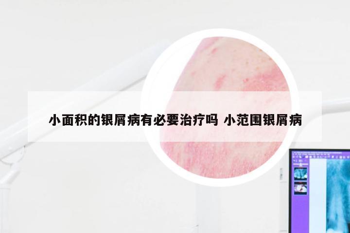 小面积的银屑病有必要治疗吗 小范围银屑病