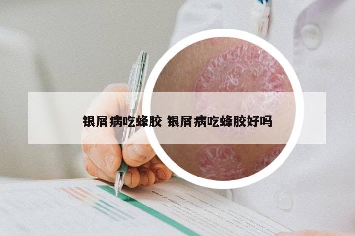 银屑病吃蜂胶 银屑病吃蜂胶好吗