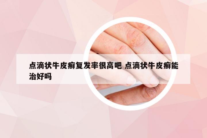点滴状牛皮癣复发率很高吧 点滴状牛皮癣能治好吗