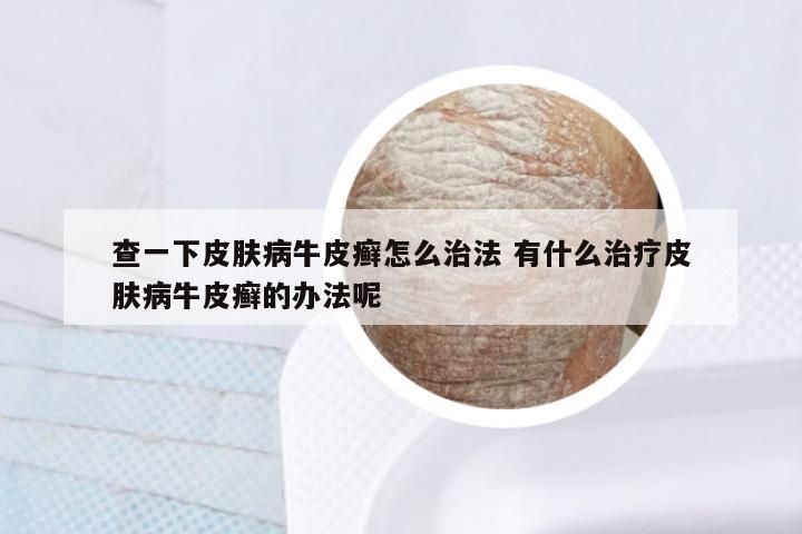 查一下皮肤病牛皮癣怎么治法 有什么治疗皮肤病牛皮癣的办法呢