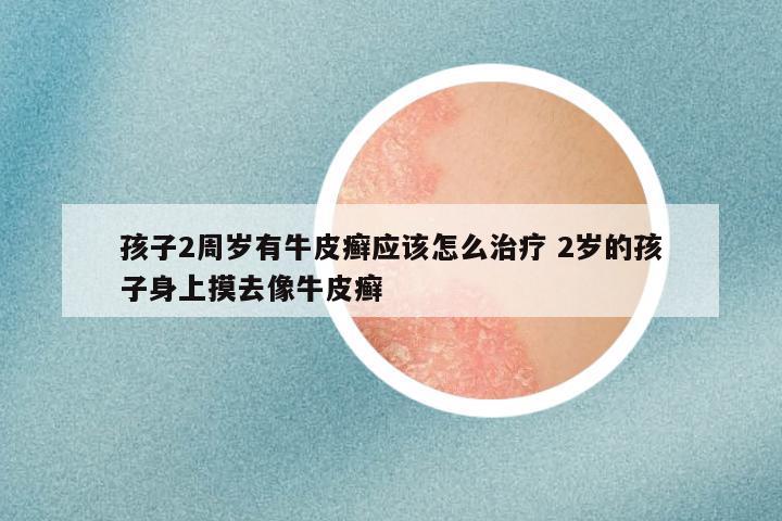 孩子2周岁有牛皮癣应该怎么治疗 2岁的孩子身上摸去像牛皮癣