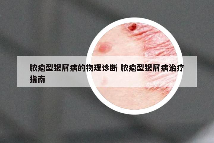 脓疱型银屑病的物理诊断 脓疱型银屑病治疗指南