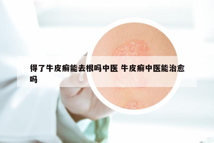 得了牛皮癣能去根吗中医 牛皮癣中医能治愈吗