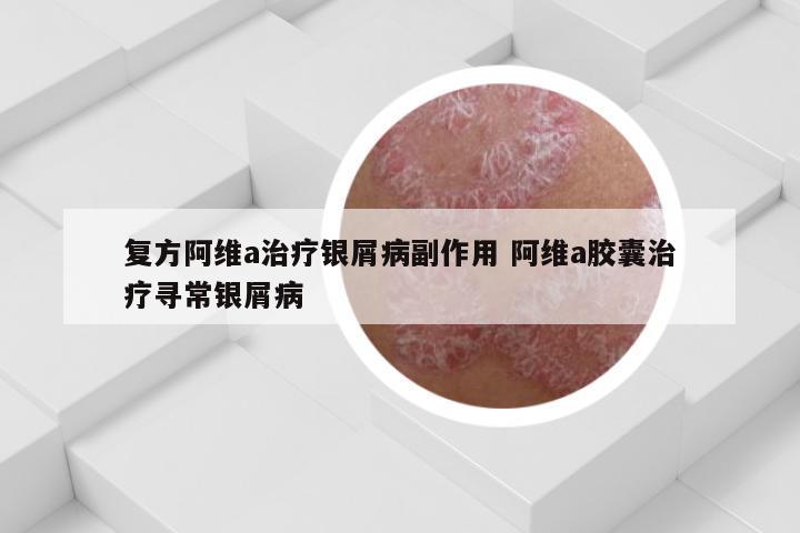 复方阿维a治疗银屑病副作用 阿维a胶囊治疗寻常银屑病
