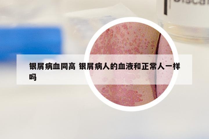 银屑病血同高 银屑病人的血液和正常人一样吗