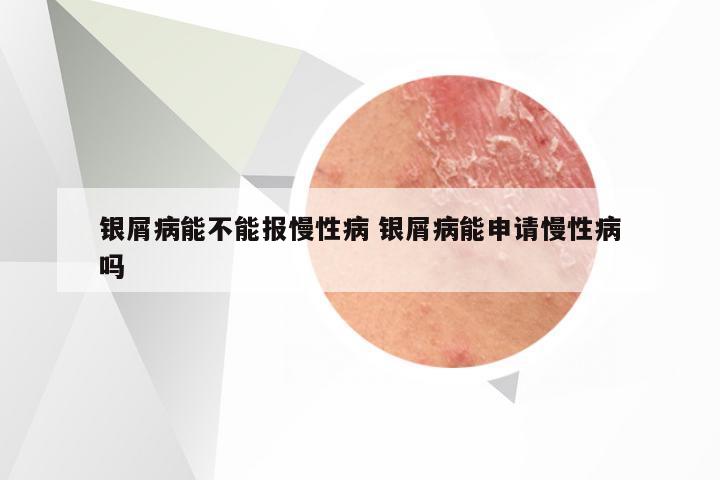 银屑病能不能报慢性病 银屑病能申请慢性病吗