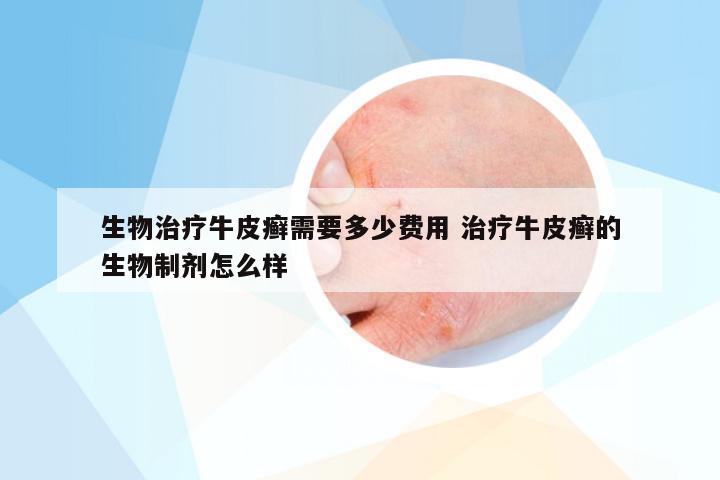 生物治疗牛皮癣需要多少费用 治疗牛皮癣的生物制剂怎么样
