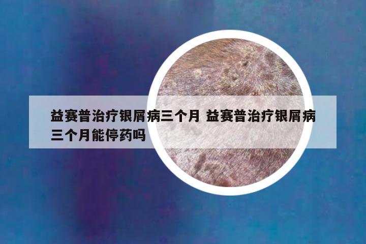 益赛普治疗银屑病三个月 益赛普治疗银屑病三个月能停药吗
