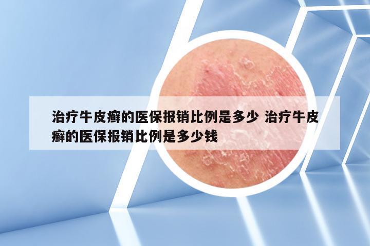 治疗牛皮癣的医保报销比例是多少 治疗牛皮癣的医保报销比例是多少钱