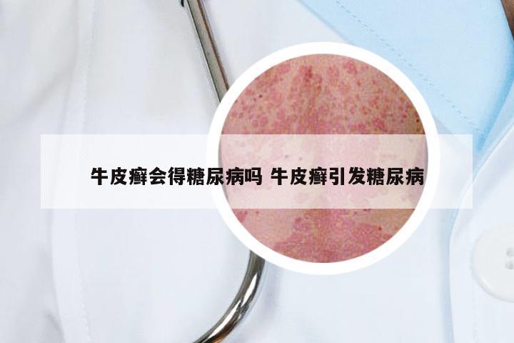 牛皮癣会得糖尿病吗 牛皮癣引发糖尿病