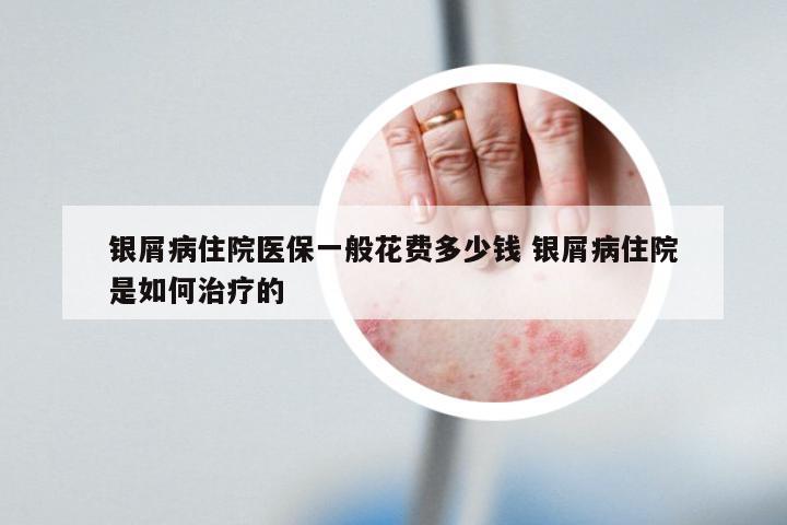 银屑病住院医保一般花费多少钱 银屑病住院是如何治疗的