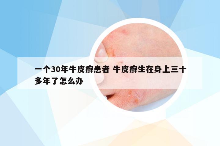 一个30年牛皮癣患者 牛皮癣生在身上三十多年了怎么办