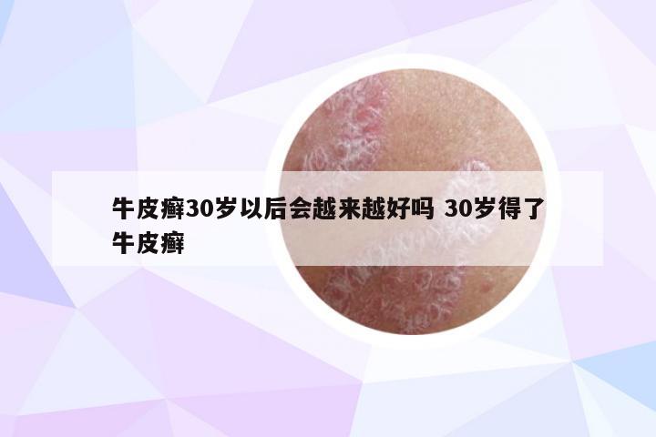 牛皮癣30岁以后会越来越好吗 30岁得了牛皮癣