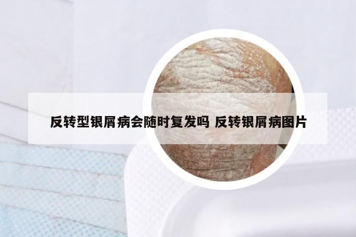 反转型银屑病会随时复发吗 反转银屑病图片