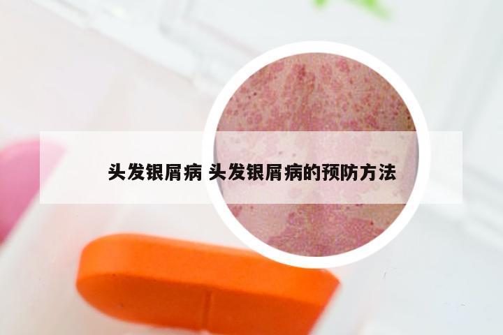 头发银屑病 头发银屑病的预防方法