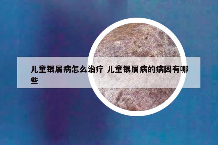 儿童银屑病怎么治疗 儿童银屑病的病因有哪些