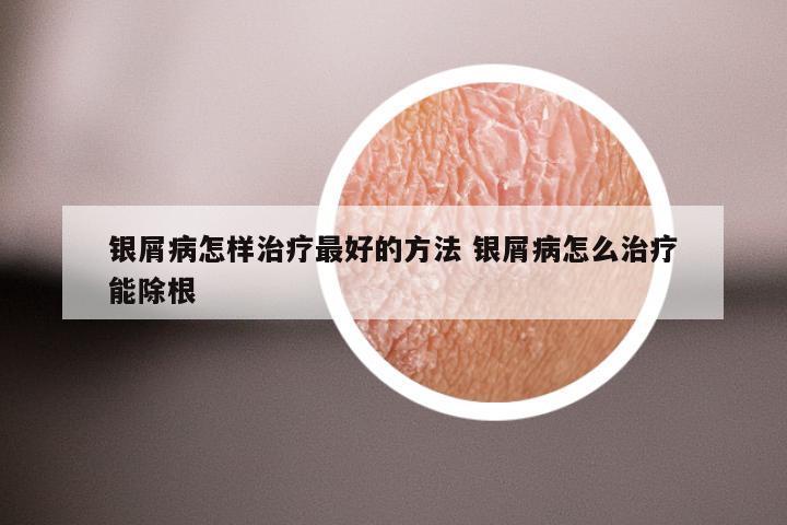 银屑病怎样治疗最好的方法 银屑病怎么治疗能除根