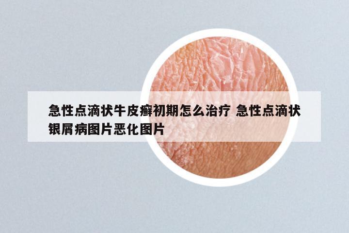 急性点滴状牛皮癣初期怎么治疗 急性点滴状银屑病图片恶化图片
