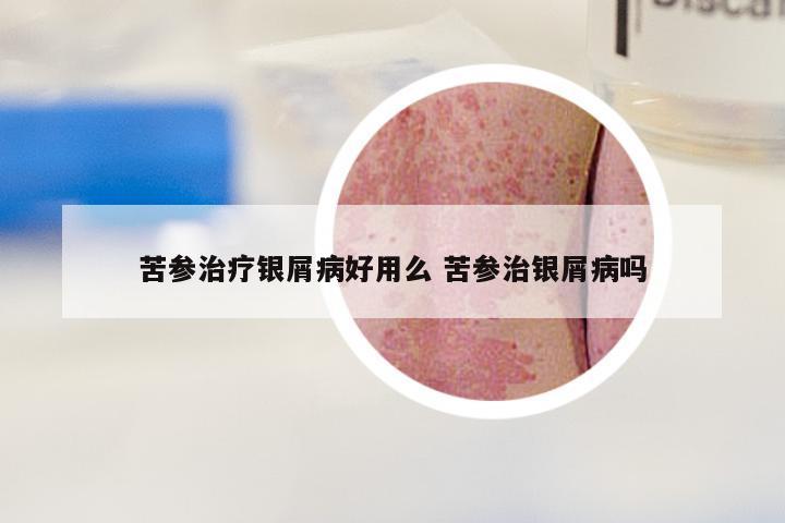 苦参治疗银屑病好用么 苦参治银屑病吗