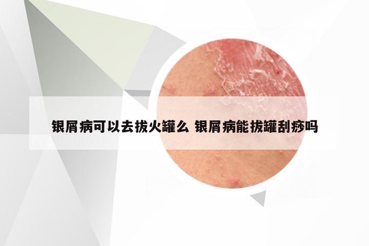 银屑病可以去拔火罐么 银屑病能拔罐刮痧吗