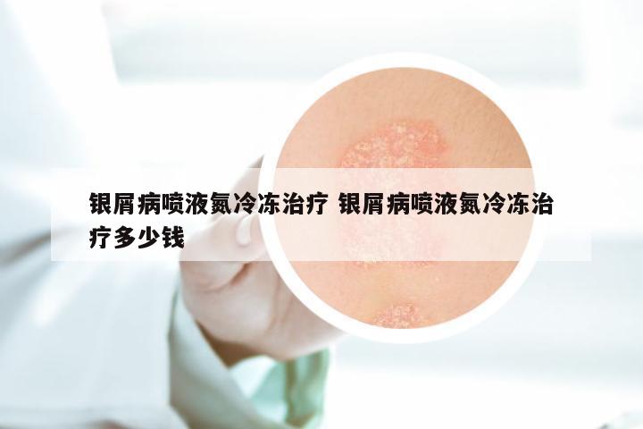银屑病喷液氮冷冻治疗 银屑病喷液氮冷冻治疗多少钱