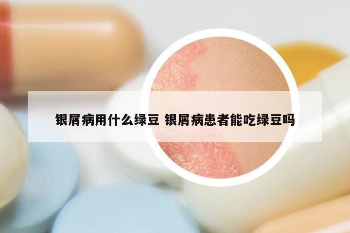 银屑病用什么绿豆 银屑病患者能吃绿豆吗