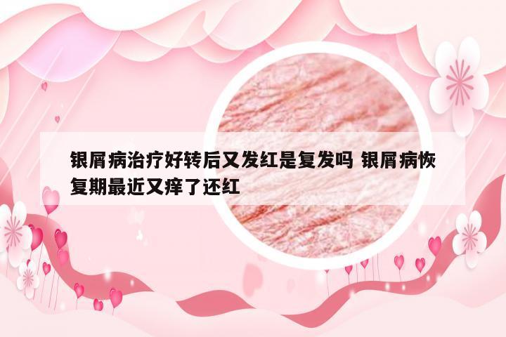 银屑病治疗好转后又发红是复发吗 银屑病恢复期最近又痒了还红