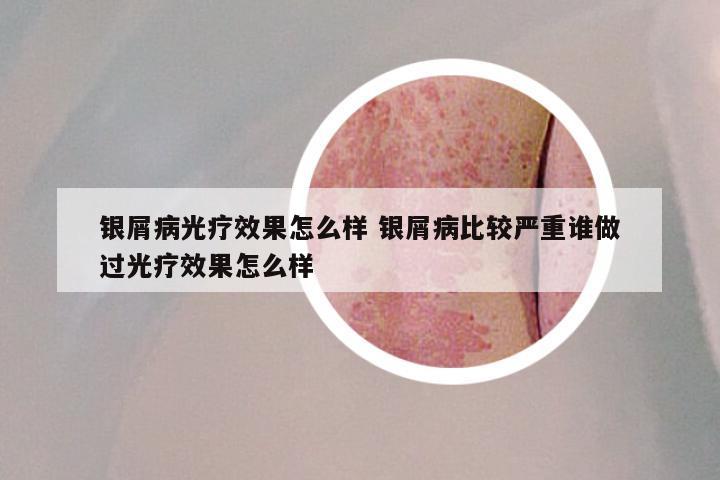 银屑病光疗效果怎么样 银屑病比较严重谁做过光疗效果怎么样