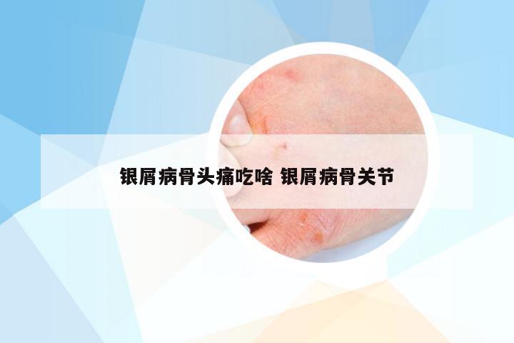 银屑病骨头痛吃啥 银屑病骨关节