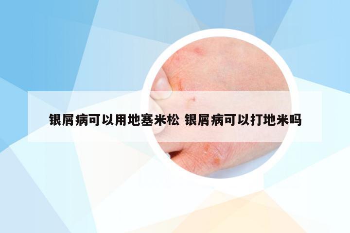 银屑病可以用地塞米松 银屑病可以打地米吗