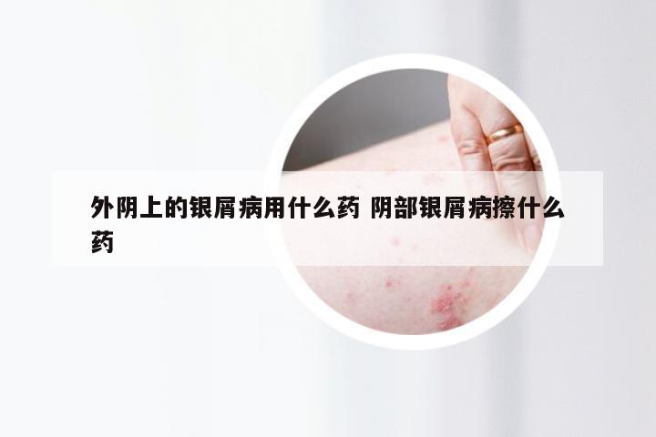 外阴上的银屑病用什么药 阴部银屑病擦什么药