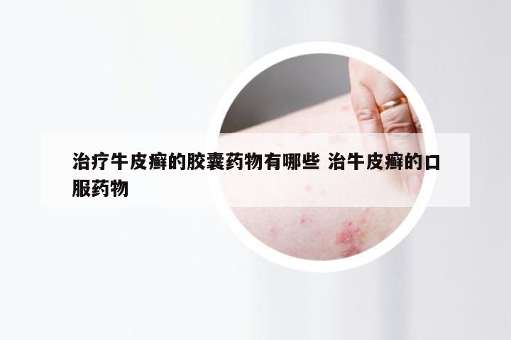 治疗牛皮癣的胶囊药物有哪些 治牛皮癣的口服药物