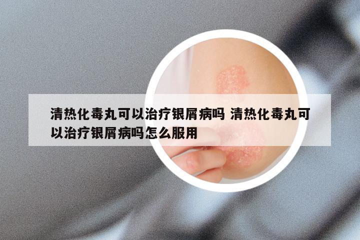 清热化毒丸可以治疗银屑病吗 清热化毒丸可以治疗银屑病吗怎么服用