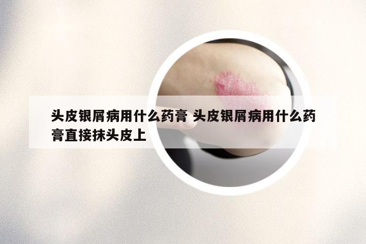 头皮银屑病用什么药膏 头皮银屑病用什么药膏直接抹头皮上