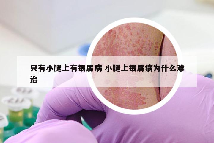 只有小腿上有银屑病 小腿上银屑病为什么难治