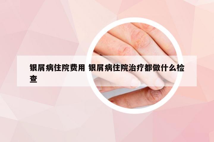 银屑病住院费用 银屑病住院治疗都做什么检查