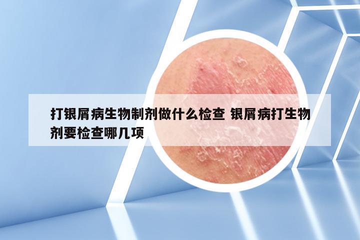 打银屑病生物制剂做什么检查 银屑病打生物剂要检查哪几项