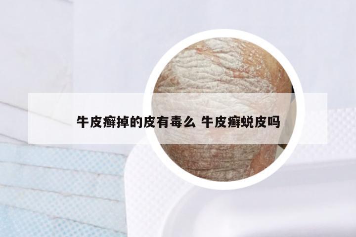 牛皮癣掉的皮有毒么 牛皮癣蜕皮吗