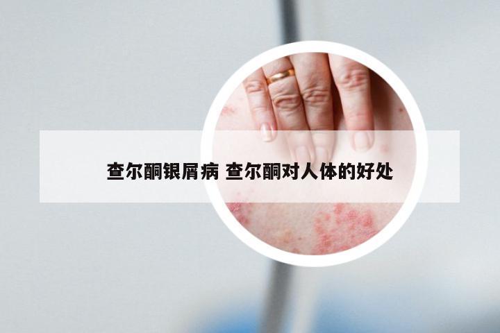 查尔酮银屑病 查尔酮对人体的好处