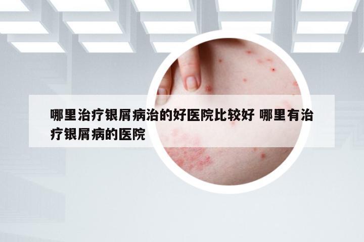 哪里治疗银屑病治的好医院比较好 哪里有治疗银屑病的医院