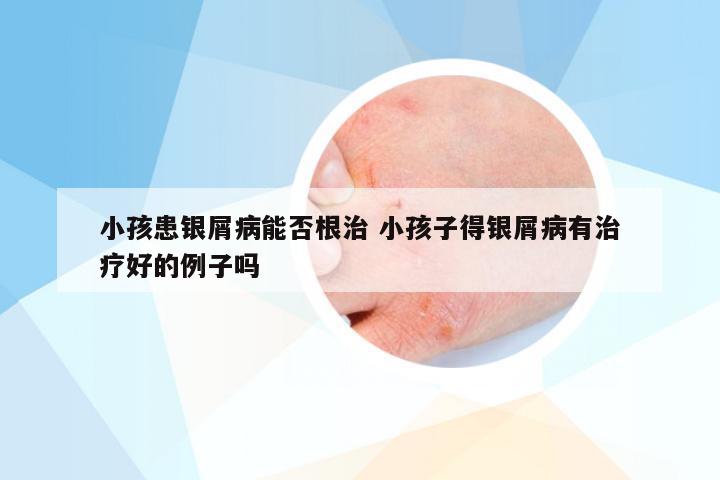 小孩患银屑病能否根治 小孩子得银屑病有治疗好的例子吗