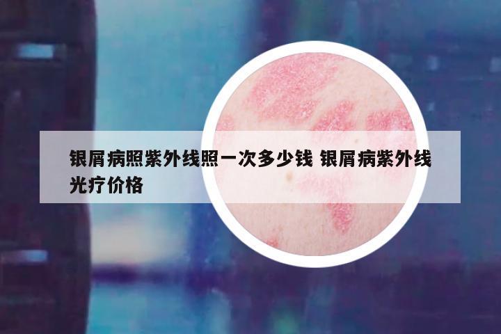 银屑病照紫外线照一次多少钱 银屑病紫外线光疗价格