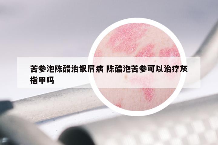 苦参泡陈醋治银屑病 陈醋泡苦参可以治疗灰指甲吗