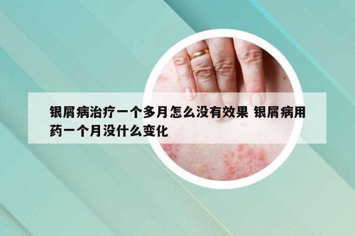 银屑病治疗一个多月怎么没有效果 银屑病用药一个月没什么变化